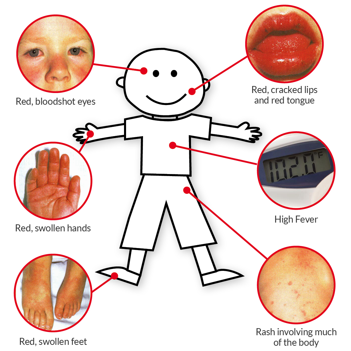 krig lejer køre Kawasaki Disease Symptoms | Kawasaki Kids Foundation